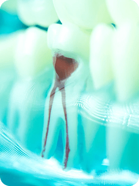 Gentle root canal treatment to save and preserve your natural tooth