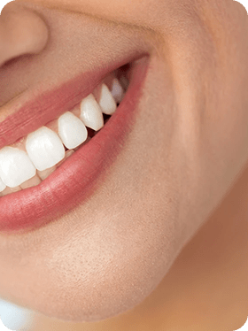 Bright white smile after professional teeth whitening treatment