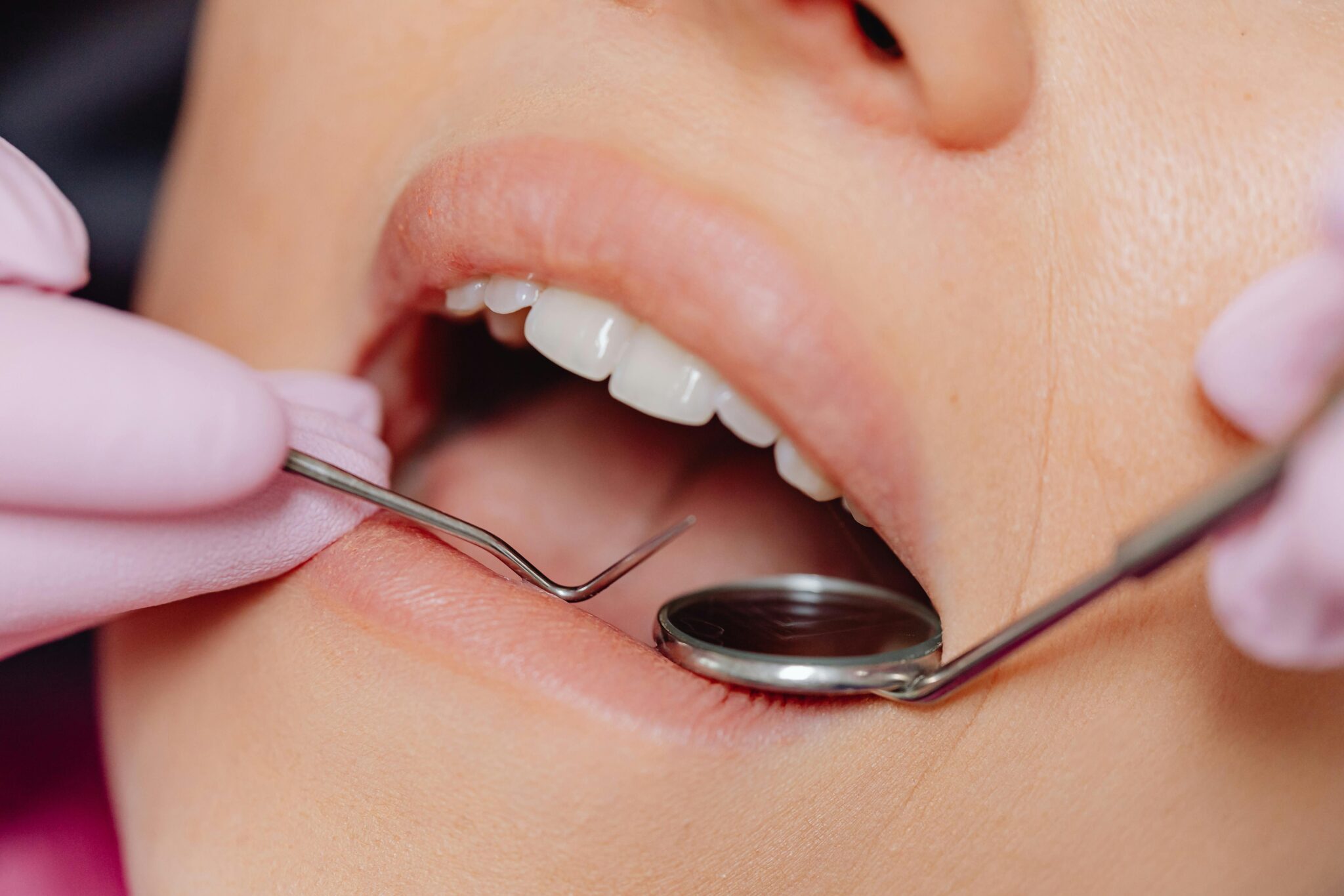 Patient receiving gentle professional teeth cleaning at Inspire Dental in Mesquite, Garland, and Balch Springs TX