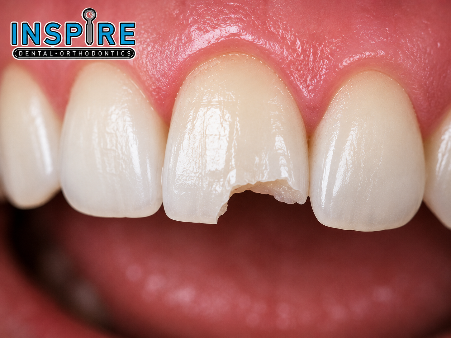Person with a broken or knocked-out tooth getting emergency care at Inspire Dental and Orthodontics