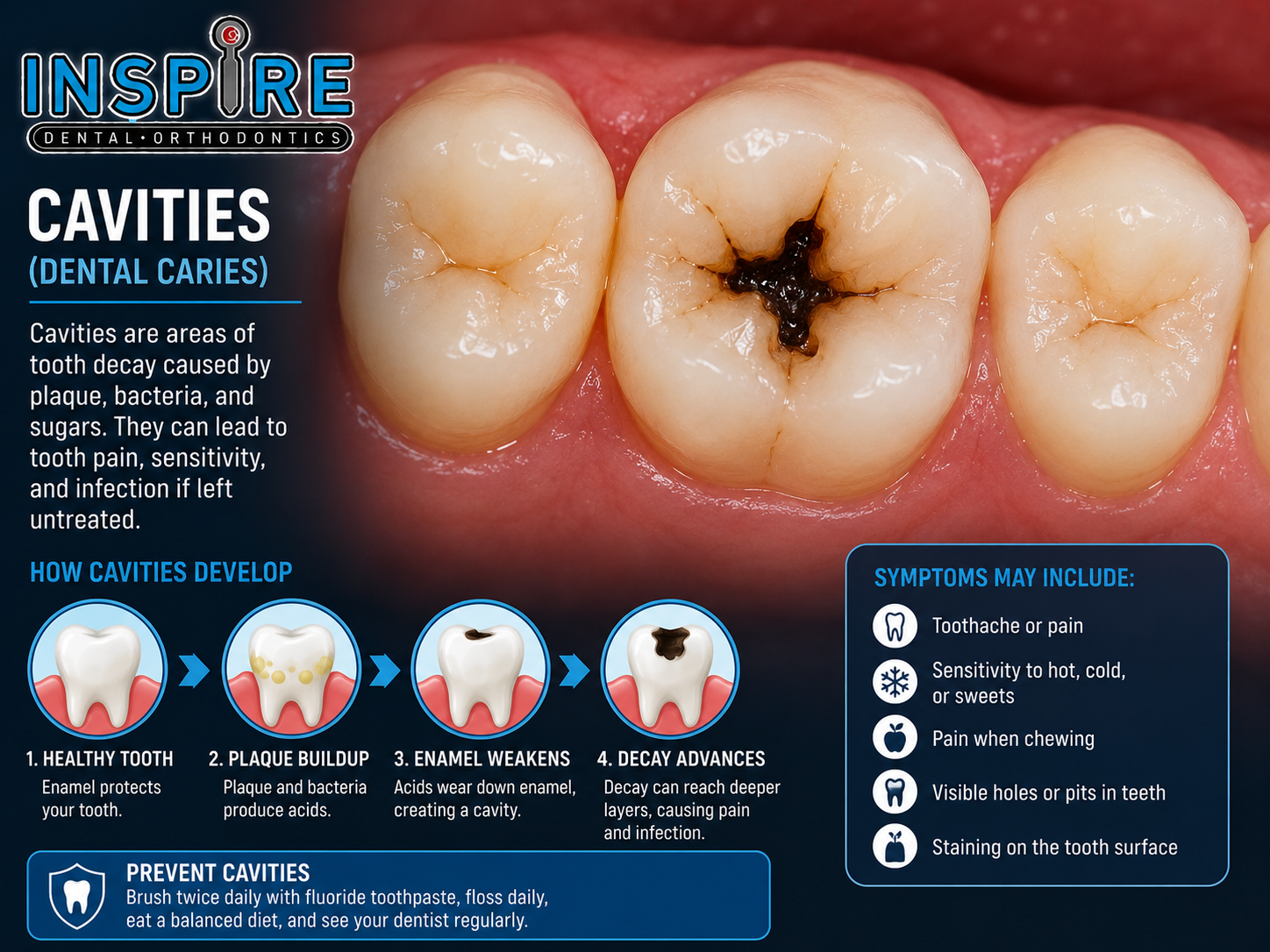 Close view of a tooth with a cavity before treatment at Inspire Dental and Orthodontics