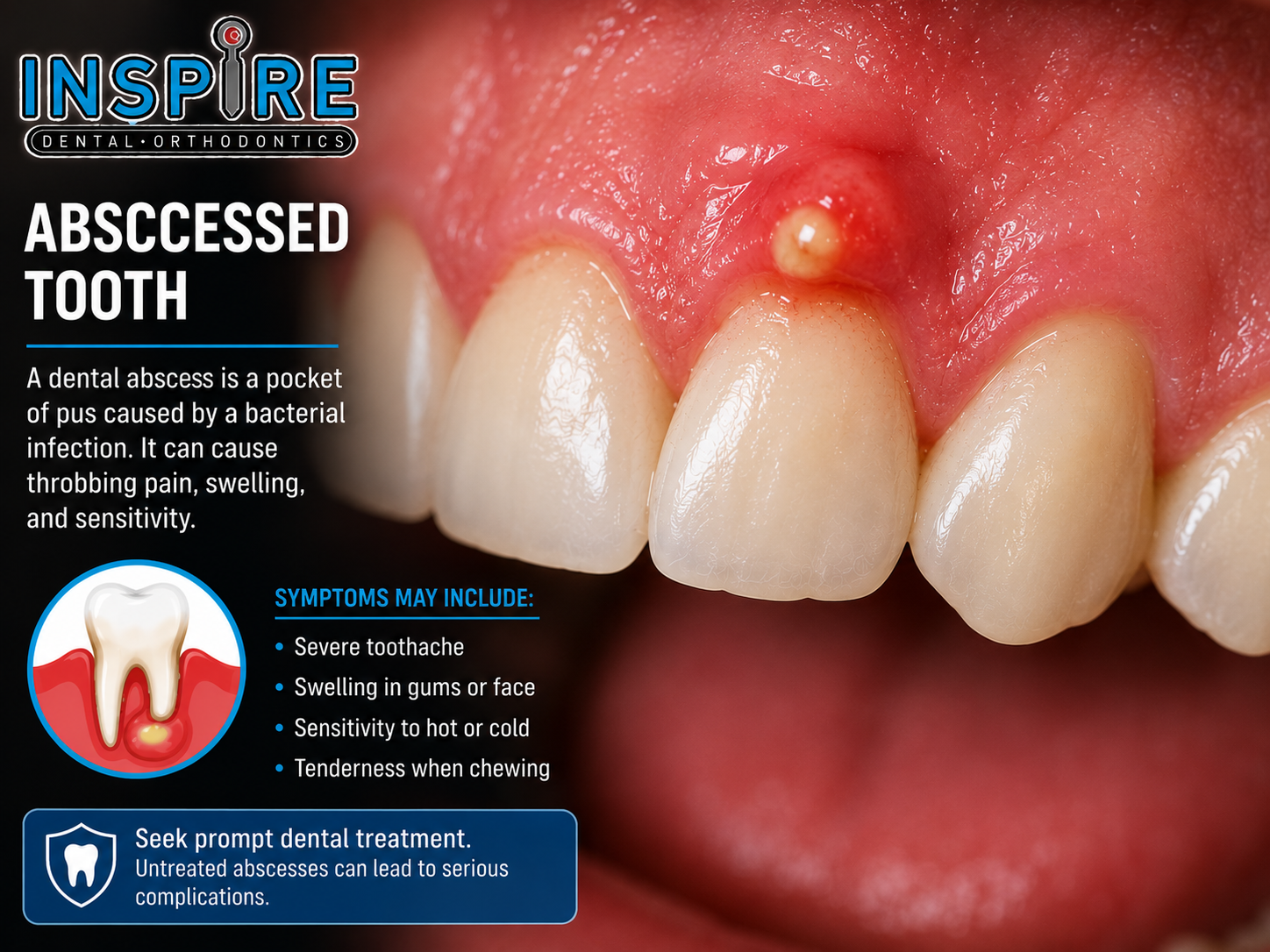 Dental abscess
