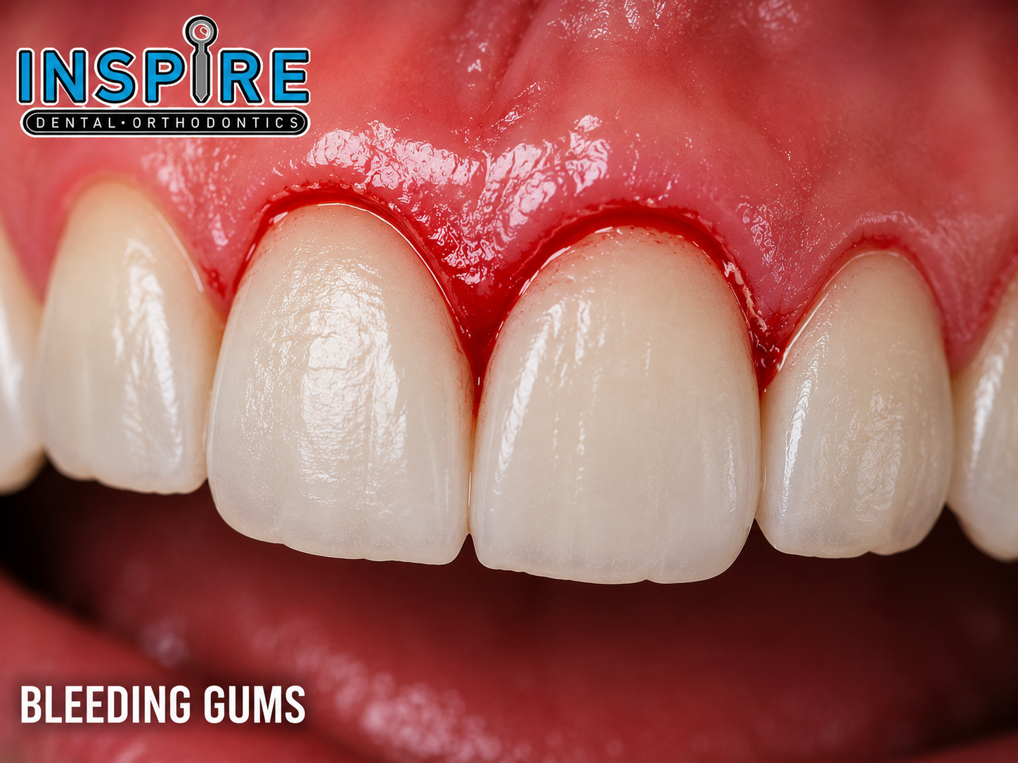 Person noticing bleeding gums while brushing before treatment at Inspire Dental and Orthodontics