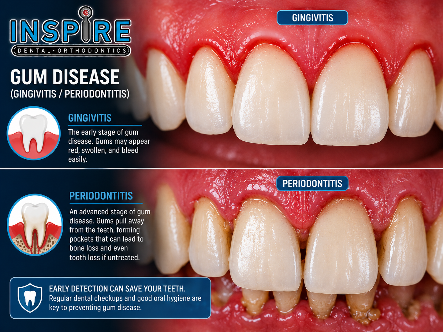 Comparison of healthy gums and gums affected by gum disease before treatment at Inspire Dental and Orthodontics