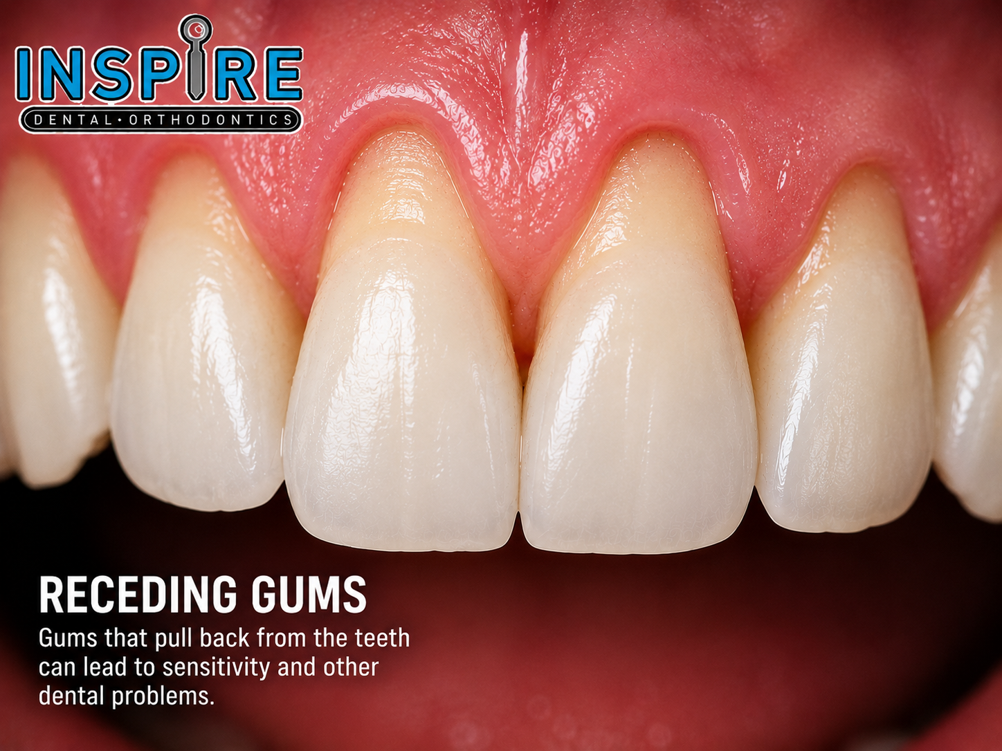 Close view of receding gums and exposed tooth roots before treatment at Inspire Dental and Orthodontics