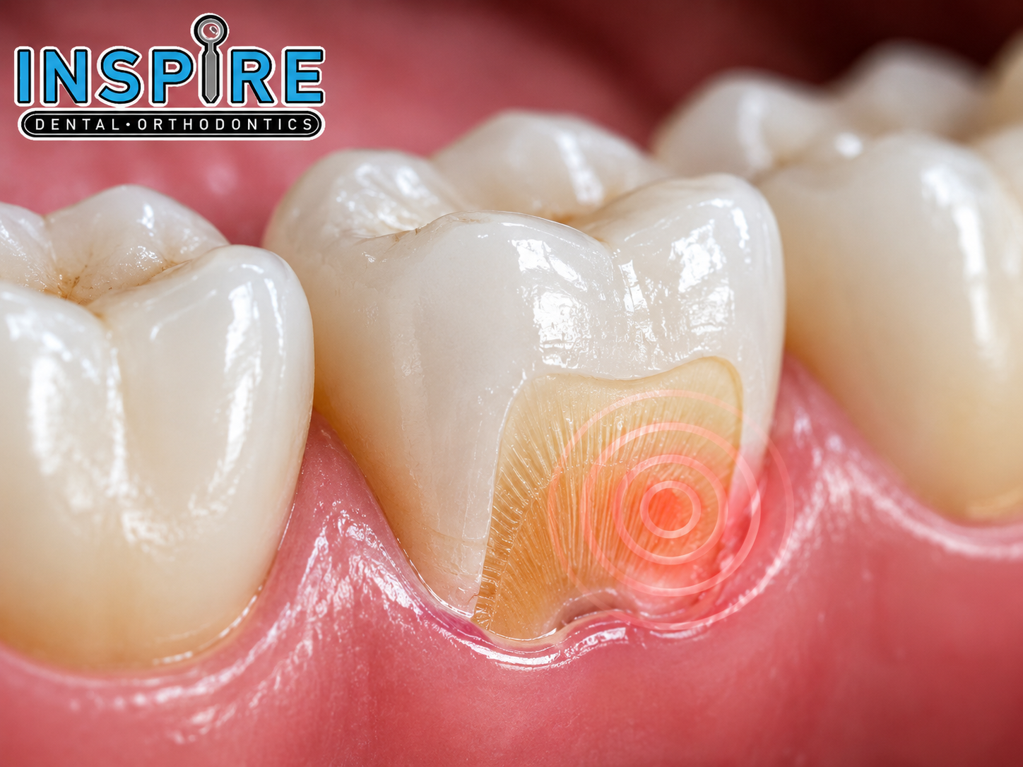 Person wincing with tooth sensitivity while eating cold food before treatment at Inspire Dental and Orthodontics