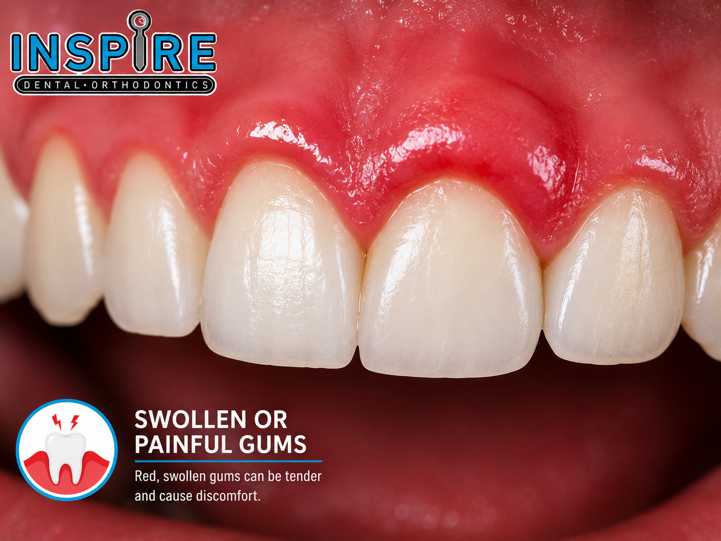Person with swollen, painful gums before treatment at Inspire Dental and Orthodontics